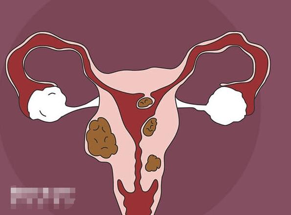 子宫肌瘤的症状有哪些表现(如何预防子宫肌瘤)