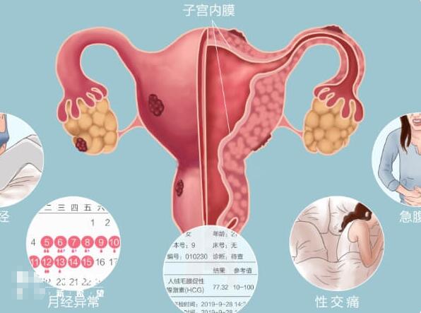子宫内膜异位症常见的临床表现有哪些？