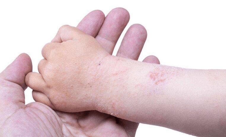成人和儿童荨麻疹的区别(成人和儿童荨麻疹症状差别)