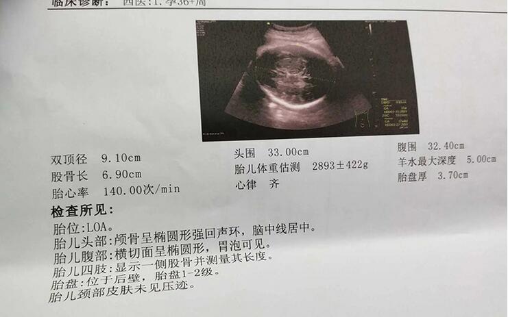 孕34周双顶径偏小是否会影响智力发育(双顶径大小与胎儿智力发育的相关联系