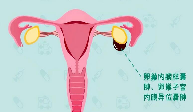 巧克力囊肿患者怀孕几率分析(巧克力囊肿对怀孕的影响)