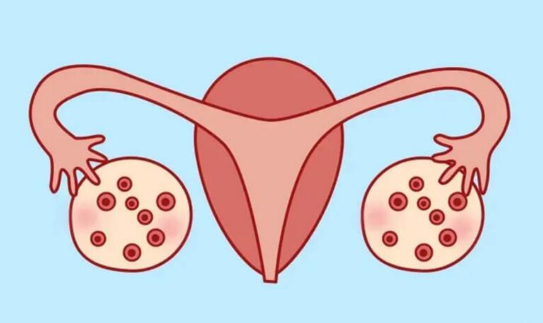中药调理多囊卵巢多久见效(多囊卵巢吃那些中药有治疗效果)