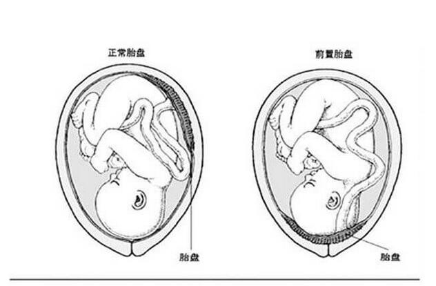 子宫前位是前置胎盘吗(预防胎位前置的方法)