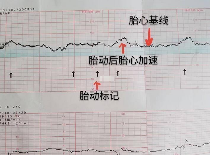 四维看男孩女孩诀窍(四维彩超怎么看胎儿是否正常)