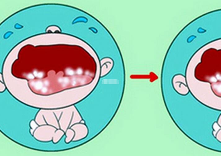 幼儿鹅口疮最早期症状图片(婴儿口腔溃疡和鹅口疮的区别)