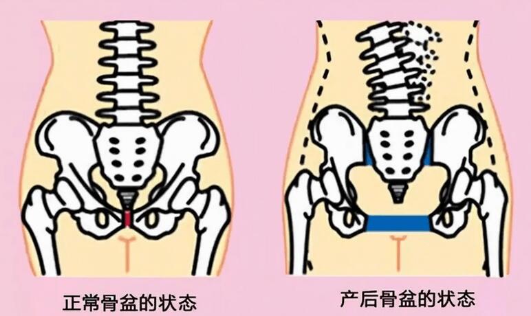 骨盆修复一般费用是多少(骨盆修复价格影响因素)