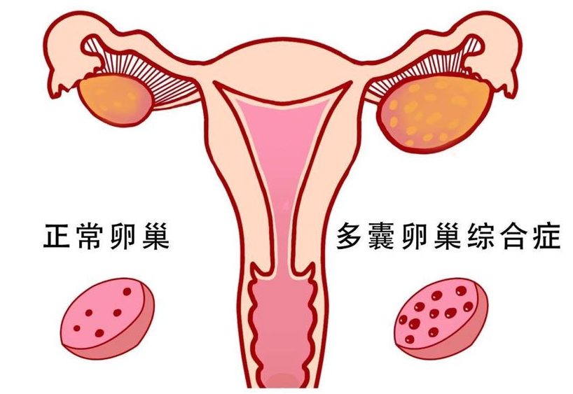 多囊卵巢如何备孕成功(多囊怀孕后如何保胎)