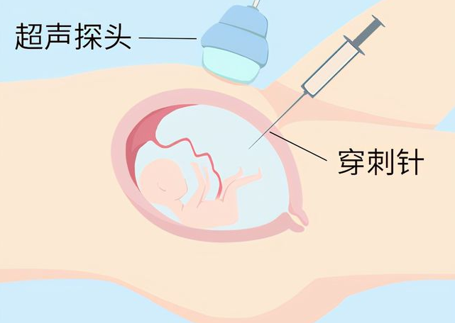 哪些疾病羊水穿刺仍不能排除(附4类疾病)