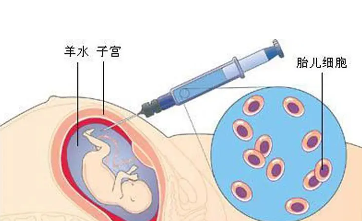 羊水穿刺的风险和副作用(做了羊水穿刺坐着上班可以吗)