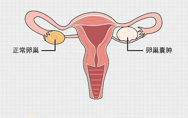 卵巢囊肿有几种(预防卵巢囊肿的方法)