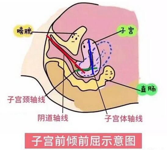 孕前、孕中子宫前位的原因(子宫后位变前位的原因)