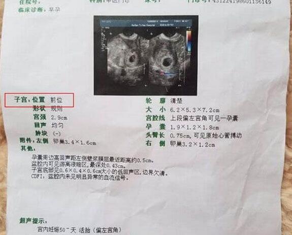 孕前、孕中子宫前位的原因(子宫后位变前位的原因)