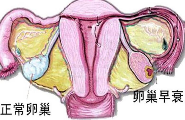 卵巢早衰的症状有哪些(卵巢早衰的治疗方法)