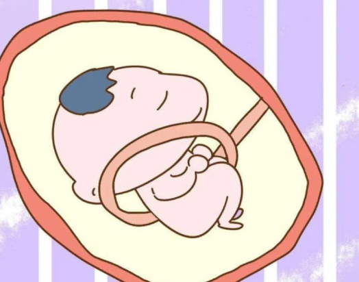 孕晚期脐带绕颈一圈怎么办（如何预防孕晚期脐带绕颈）