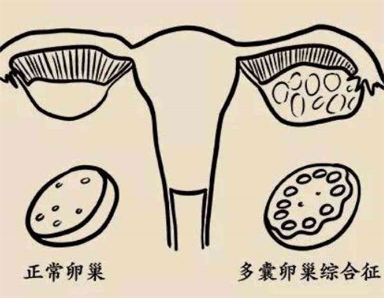 多囊卵巢如何快速受孕有办法！做好这几步成功抱娃不是问题