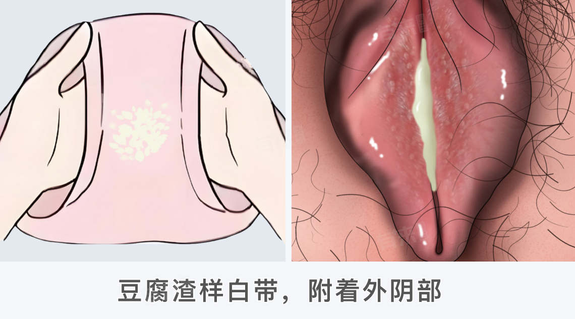 霉菌性阴道炎是什么样子？