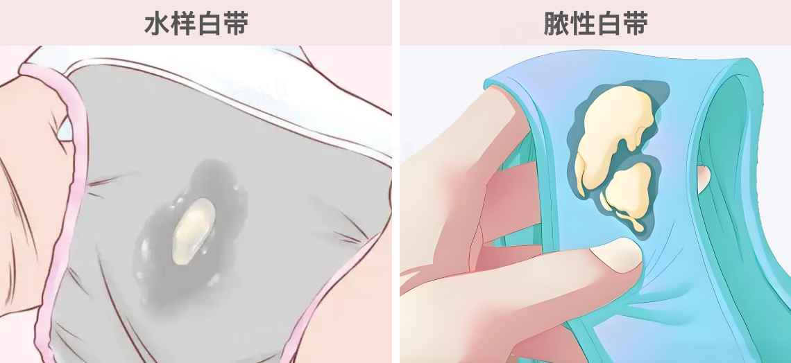 阴道癌的症状是什么样的？