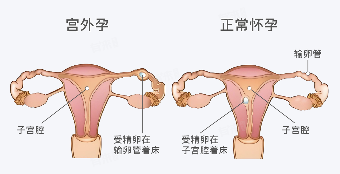 宫外孕会有什么样的症状表现？