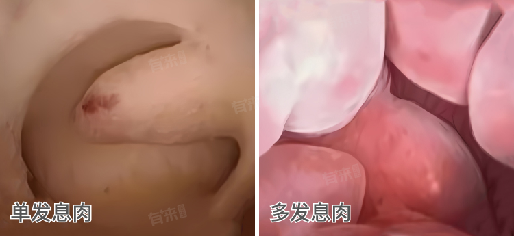 子宫息肉是什么样子的？