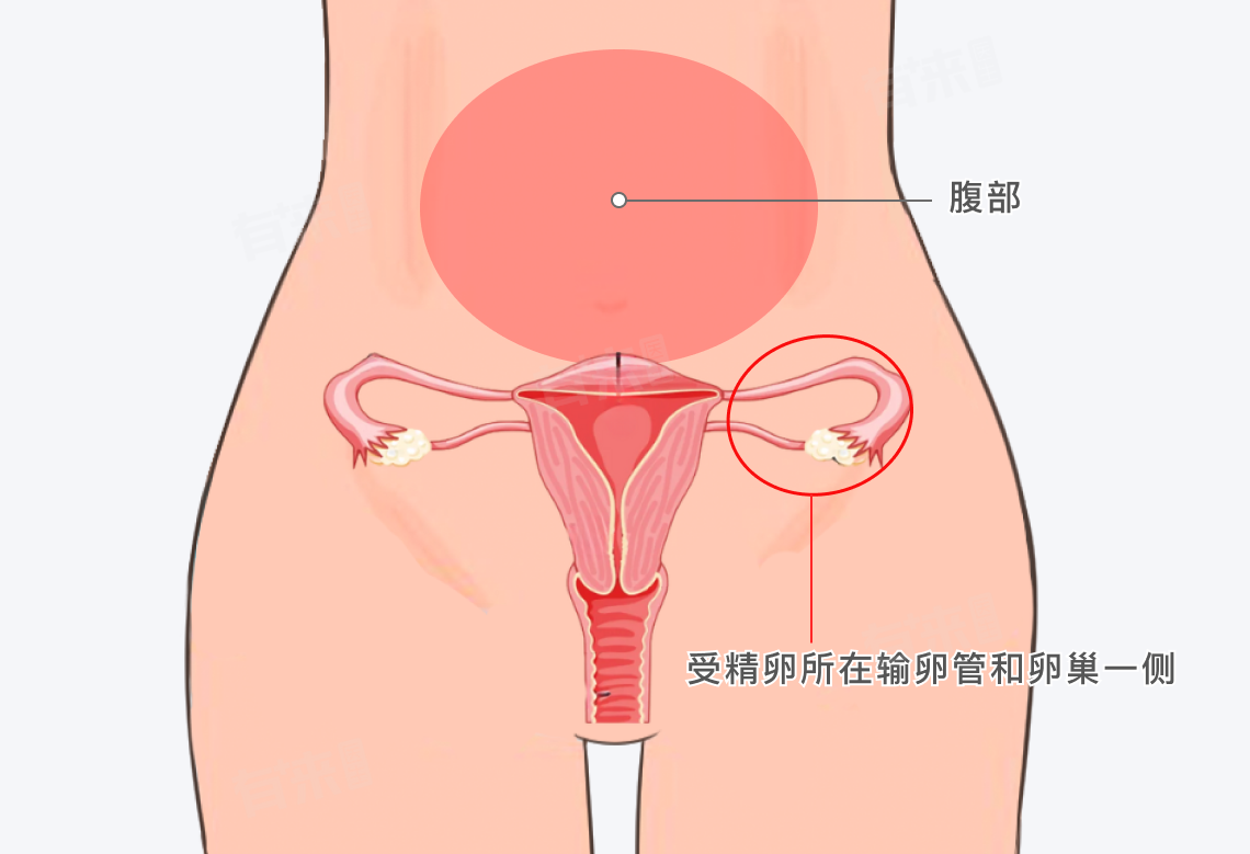 宫外孕按压哪里会疼？