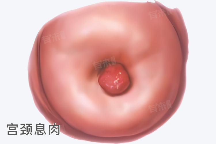 子宫息肉是什么样子的？