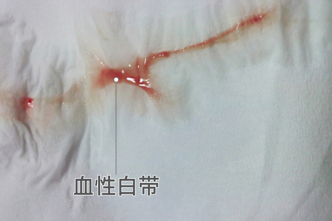 先兆流产什么样的？
