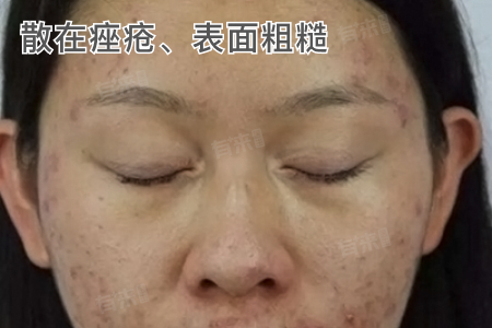 多囊卵巢综合征是什么样？