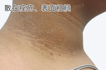 多囊卵巢综合征是什么样？