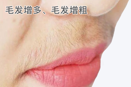 多囊卵巢综合征是什么样？