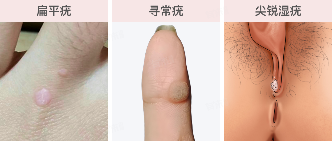 女性HPV感染都有什么症状？