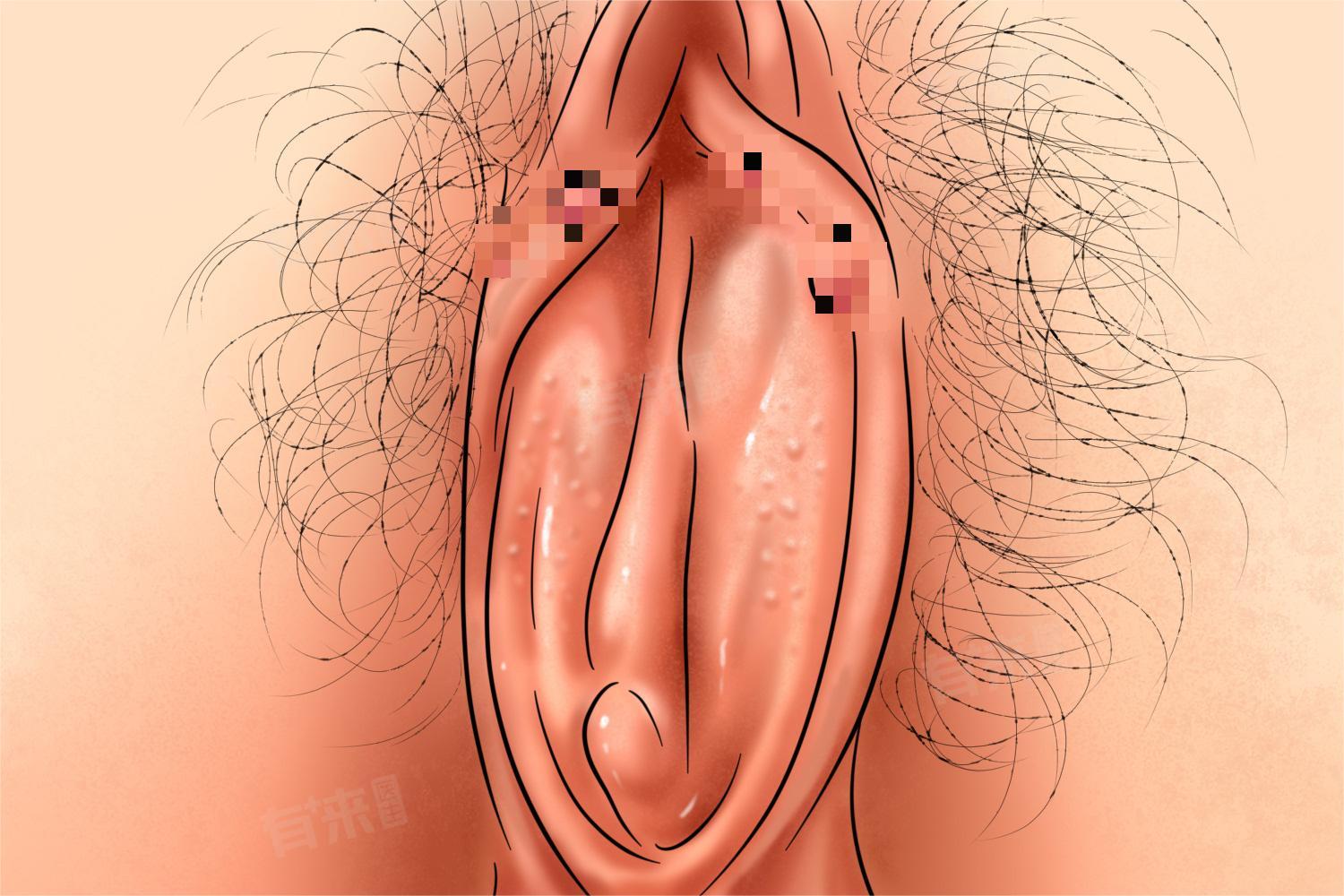 阴唇一边大一边小,是怎么回事？