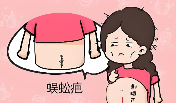 剖腹产疤痕增生丑哭？皮肤科医生教你淡化疤痕的最佳黄金期