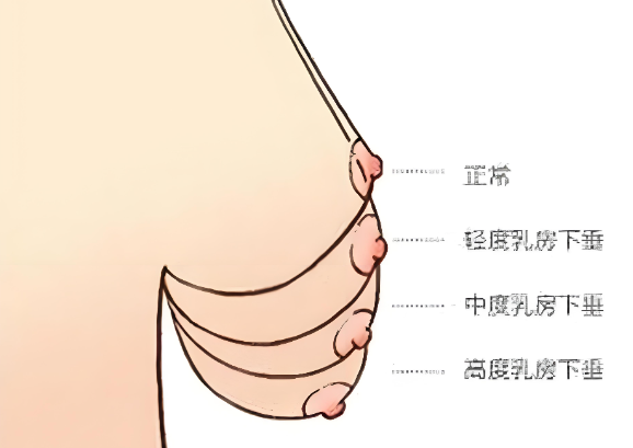 母乳喂养会导致胸部下垂吗？选对哺乳内衣和断奶时机很重要