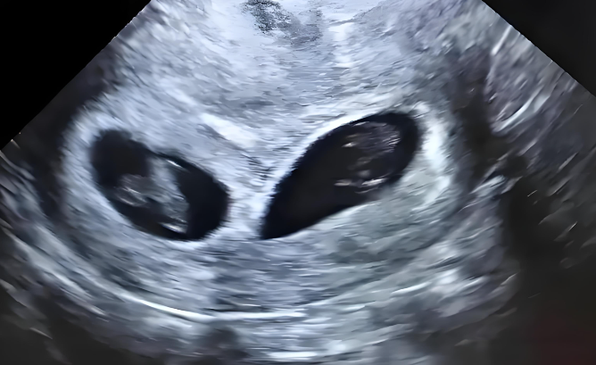 孕囊形状长条是男,圆形是女？这可能是产科最大的误会