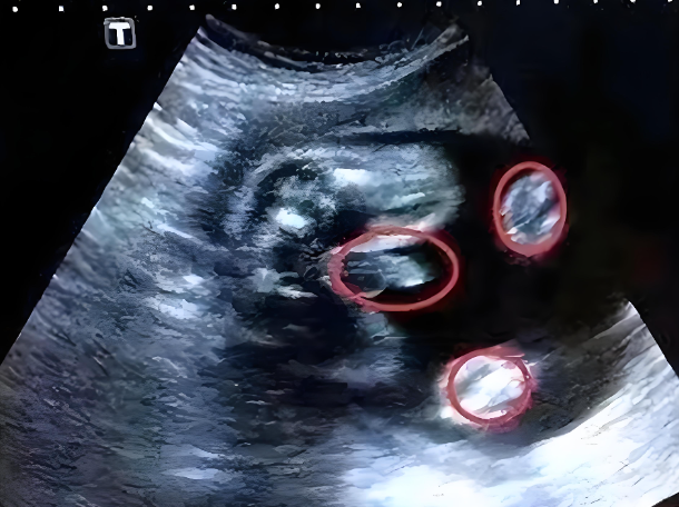 肾盂分离就是男宝宝憋尿？揭秘B超单上肾盂分离的真实含义