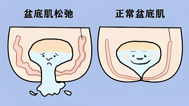 为了不松弛选择剖腹产？当心“盆底肌损伤”依然找上门