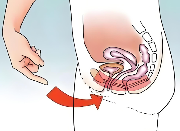 生完二胎比一胎更松弛？高龄产妇如何拯救断裂的盆底肌筋膜