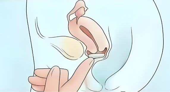 生完二胎比一胎更松弛？高龄产妇如何拯救断裂的盆底肌筋膜