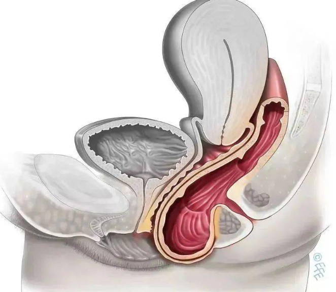 产后阴道壁膨出和子宫脱垂是怎么回事？别把松弛当小毛病