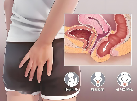 年轻妈妈也会得“社交癌”？一文看懂产后压力性尿失禁