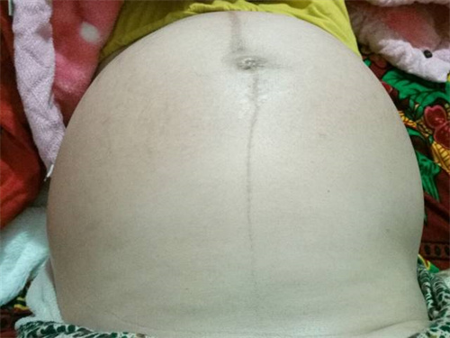 肚子上长黑线就是生男孩？带你揭开孕期