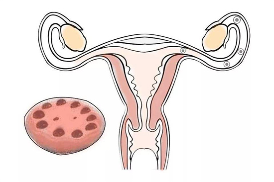 多囊卵巢综合征必看的“低GI饮食法”：吃对了一周瘦2斤，月经自然来