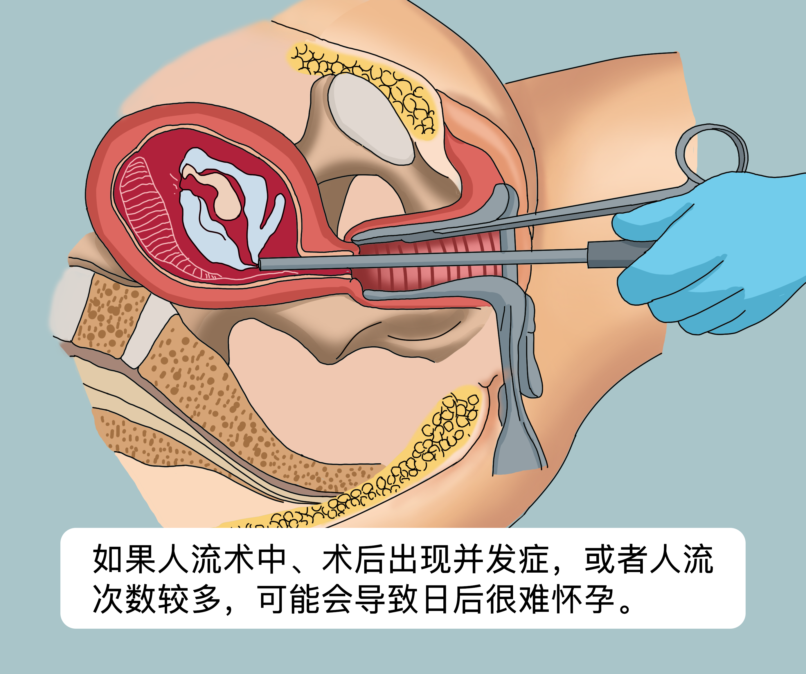 做过人流是不是很难怀孕