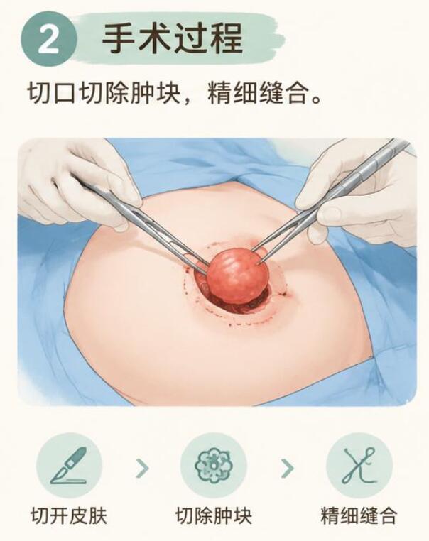 乳房肿块切除手术到底怎么做的？一篇讲清楚