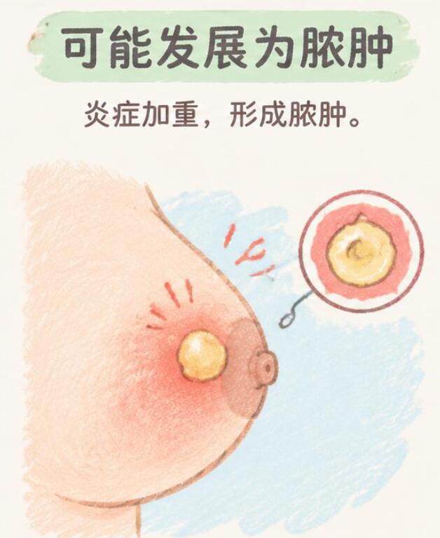 哺乳期乳腺炎不处理有什么危害？可能从“小堵奶”拖成“大麻烦”