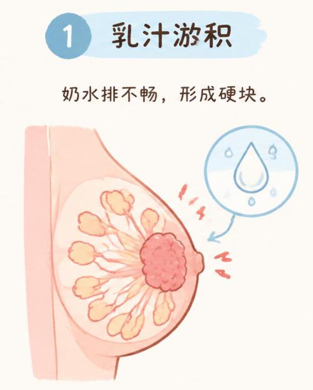 哺乳期胸部硬块+刺痛？别慌，先看这篇