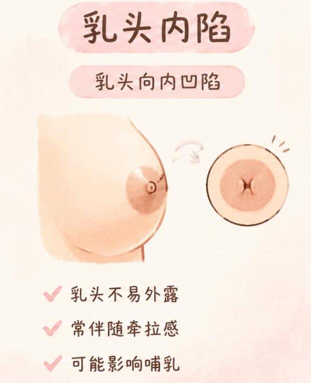 乳头内陷和乳头小有什么区别？别再搞混了！