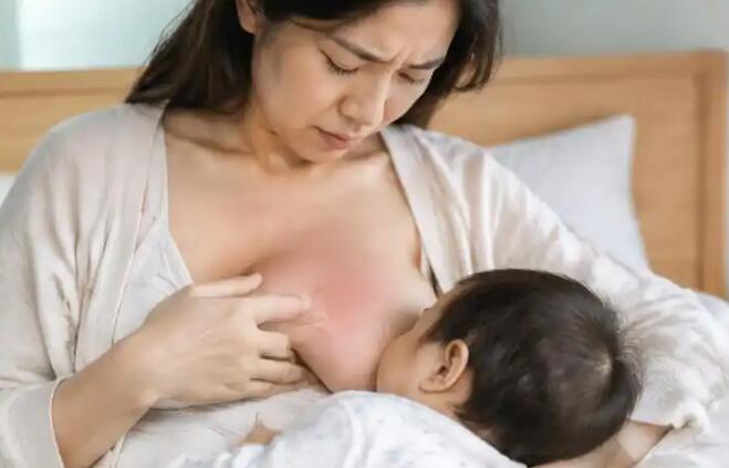 哺乳期乳腺炎怎么办？别急着停奶，先分清症状再处理