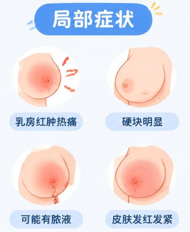 哺乳期乳腺炎症状有哪些？这些症状千万别忽视！